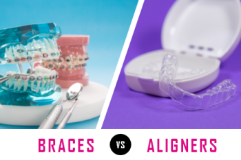 Indianapolis dentist, Dr. Sammons of the Center for Advanced Dentistry talks about what factors need to be considered when deciding between getting braces or clear aligners for corrections.