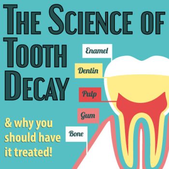 Indianapolis dentist, Dr. Sammons of Center for Advanced Dentistry, discusses the science of tooth decay: what it is and what you can do to prevent it.